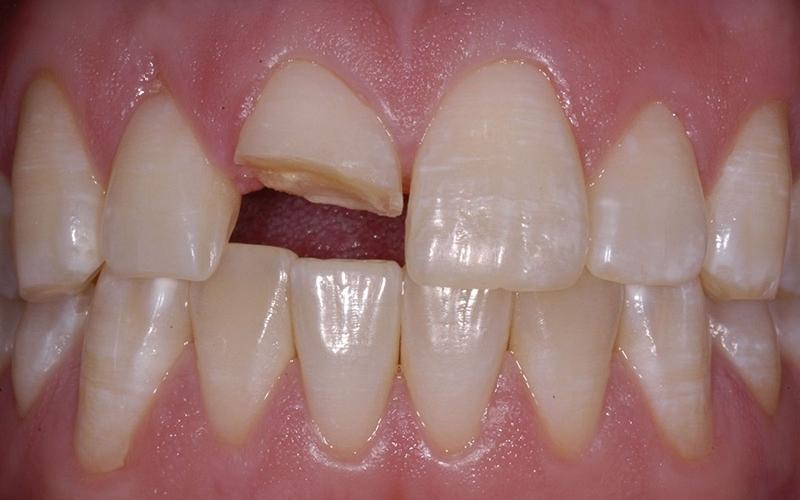 Răng mẻ, vỡ có thể khắc phục bằng bọc răng sứ