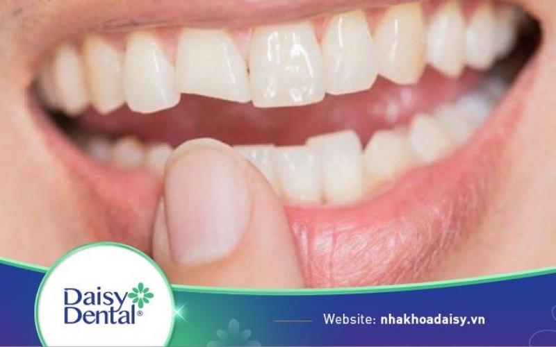 Răng Sứ Bị Mẻ Có Trám Được Không