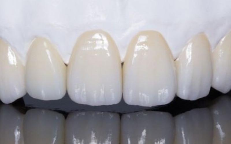 Răng sứ kim loại phù hợp với nhiều đối tượng sử dụng khác nhau