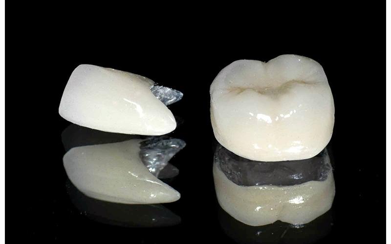 Răng sứ kim loại có tuổi thọ từ 5 - 10 năm