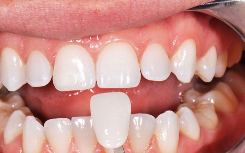 Răng sứ sau khi tháo ra không còn nguyên vẹn như ban đầu nên phải sử dụng mão sứ mới