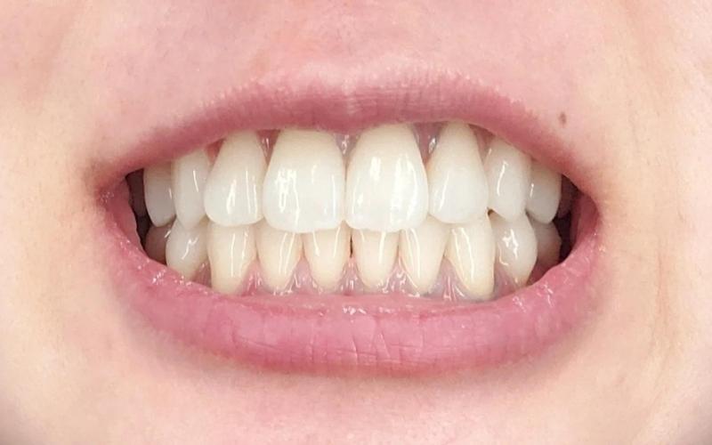 Răng sứ Titan có bị đen không