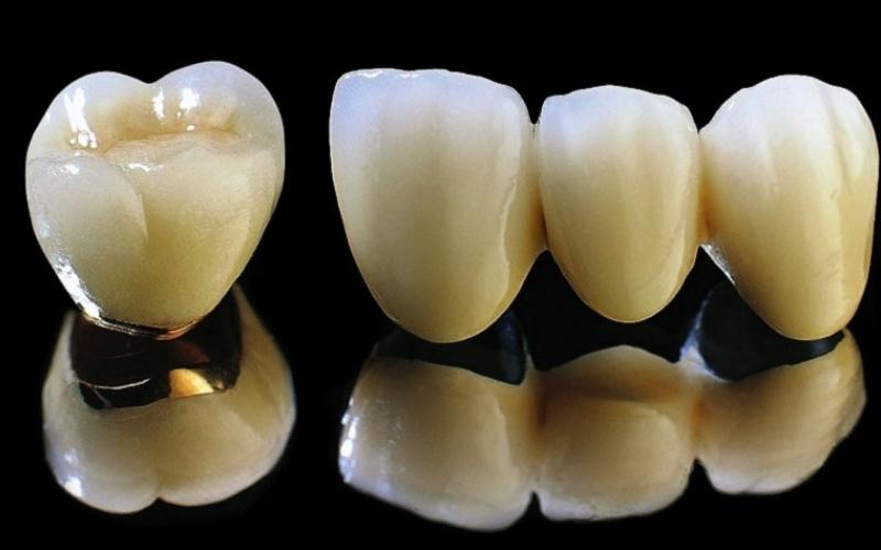 Răng sứ Titan là vật liệu được cấu thành bằng hợp kim Crom - niken - titan