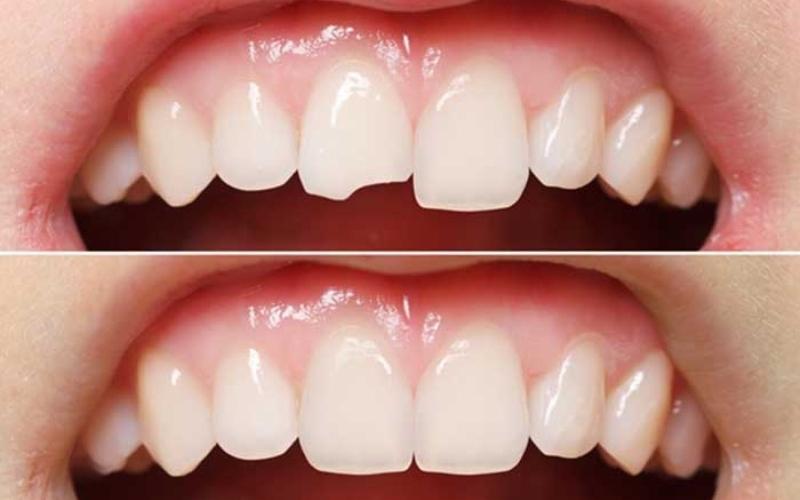 Răng bị sứt mẻ nhẹ không cần lấy tủy