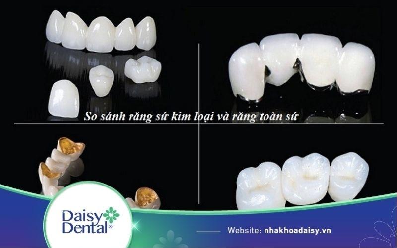 Răng toàn sứ và răng sứ Titan
