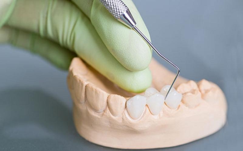 Răng sứ Cercon được chế tác dựa trên công nghệ hiện đại và quy trình thực hiện phức tạp