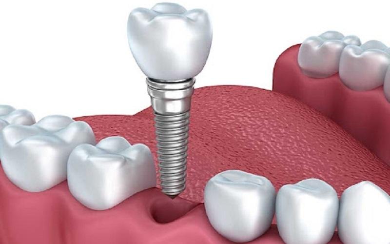 Bạn có thể trồng răng Implant để phục hình răng đã mất hiệu quả