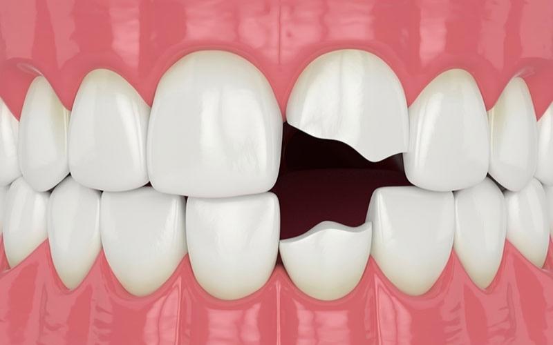 Răng bị chấn thương nặng thì việc lấy tủy là điều bắt buộc