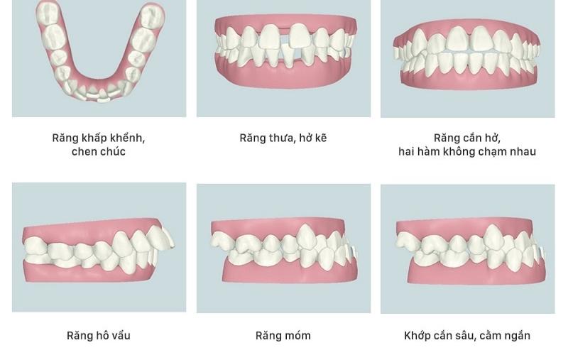 Những trường hợp nên cho trẻ niềng răng