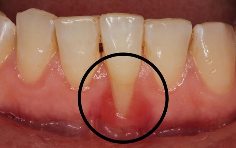 Tụt lợi sau quá trình niềng răng là tình trạng thường gặp phải