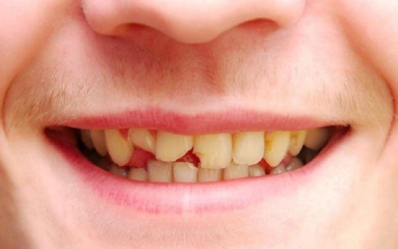 Tùy vào tình trạng răng mà bác sĩ sẽ lựa chọn phương pháp phù hợp