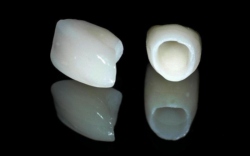 Chất liệu răng sứ Titan có vẻ đẹp thẩm mỹ cao, màu sắc đẹp