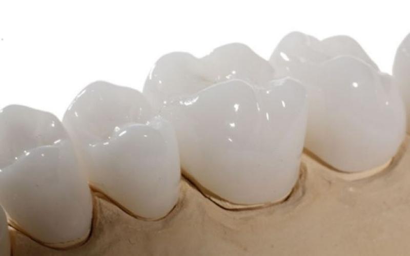 Răng sứ Zirconia có sự cải tiến hơn so với răng sứ Cercon