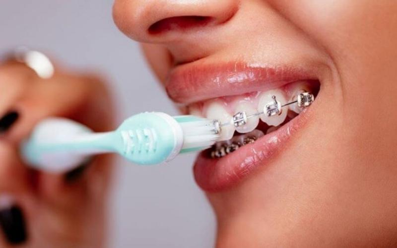 Để cải thiện tình trạng niềng răng bị sưng lợi hãy thực hiện vệ sinh răng miệng đúng cách