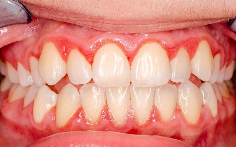 Nguyên nhân hàng đầu gây nên tình trạng sau khi bọc răng sứ răng bị chảy máu là do bệnh viêm nướu
