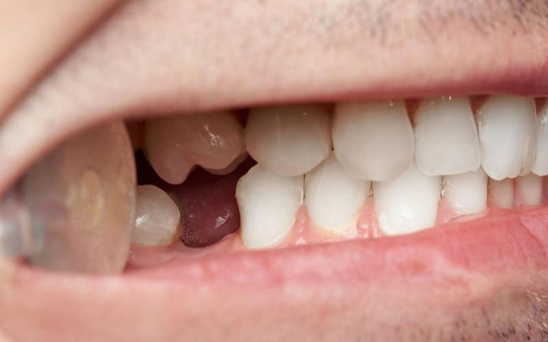 Mất răng số 6 gây khó khăn trong quá trình ăn nhai