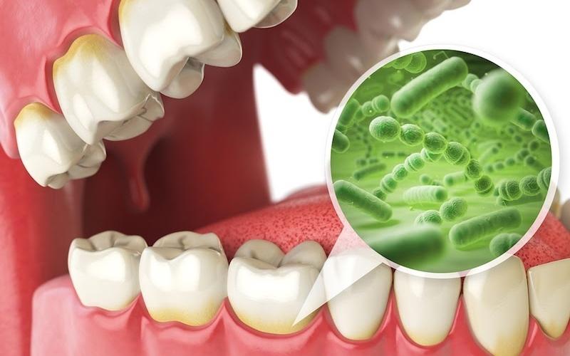 Sâu răng là tình trạng răng bị vi khuẩn tấn công gây tổn thương phần mô cứng