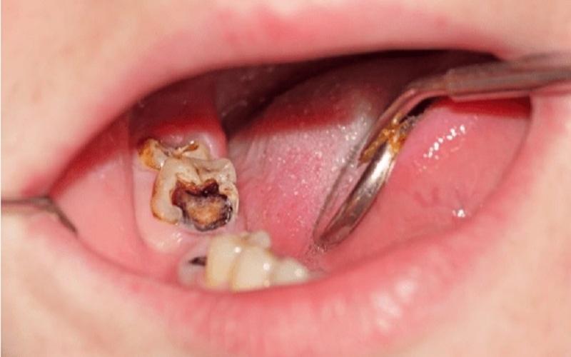Sâu răng là bệnh lý phổ biến ở người