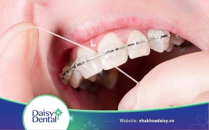 Cách dùng chỉ nha khoa cho người niềng răng