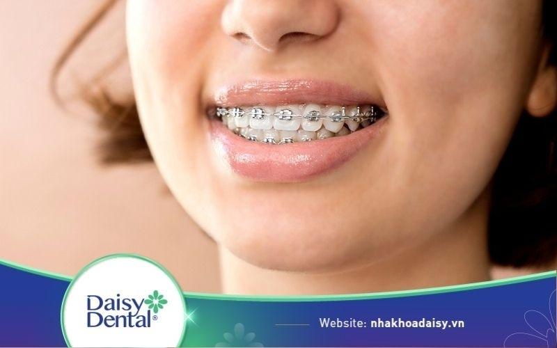 Niềng răng hô hàm trên được không? Chi phí bao nhiêu?