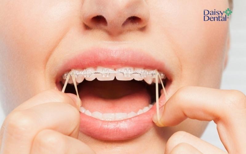 Band răng sẽ được tháo bỏ khi bác sĩ hoàn tất thời gian thực hiện chỉnh nha