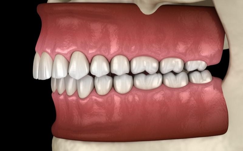 Trường hợp hô do răng và xương phải kết hợp chỉnh nha và phẫu thuật hàm