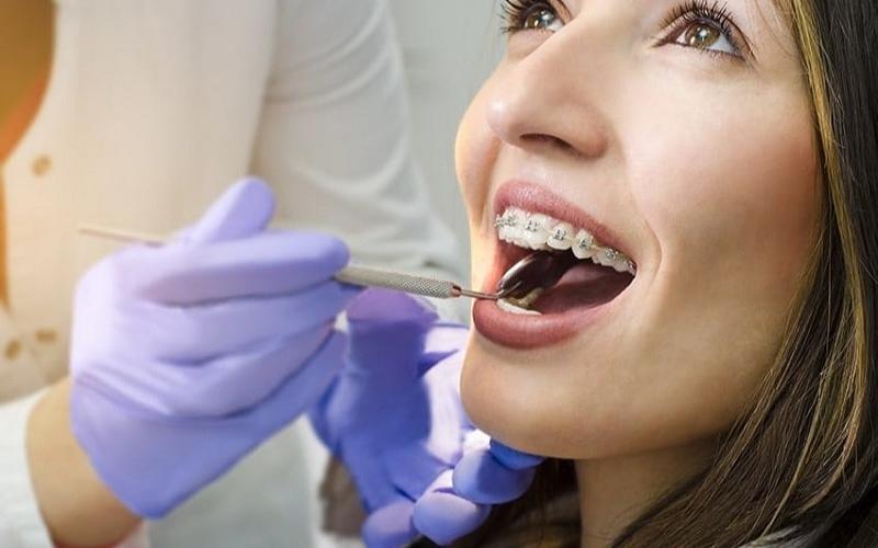 Bạn nên đến nha khoa thăm khám để biết niềng răng hàm trên có nhổ răng không