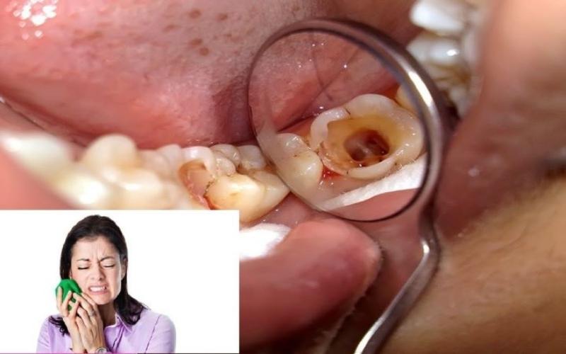 Chữa đau sâu răng tại nhà chỉ mang tính chất tạm thời