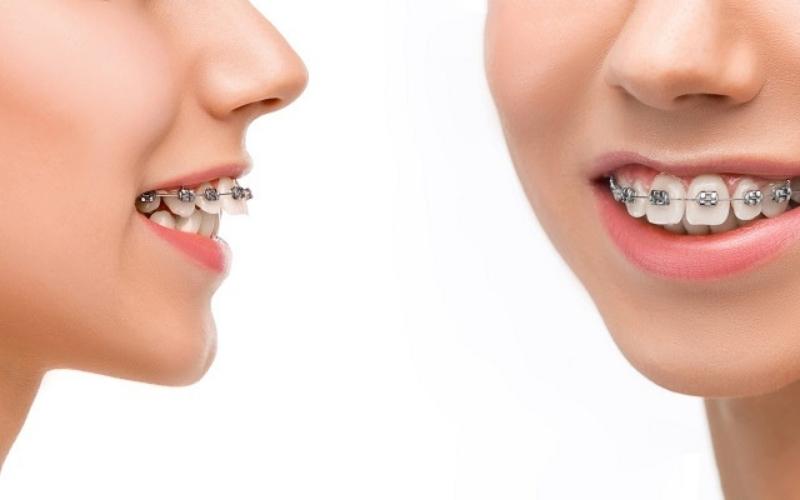 Nếu khách hàng có cung hàm rộng, răng dễ dịch chuyển thì không cần phải nhổ răng khi chỉnh nha