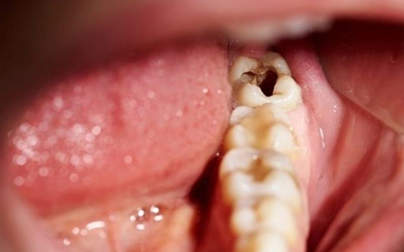 Sâu răng ở người lớn tuổi gây nên nhiều biến chứng nguy hiểm