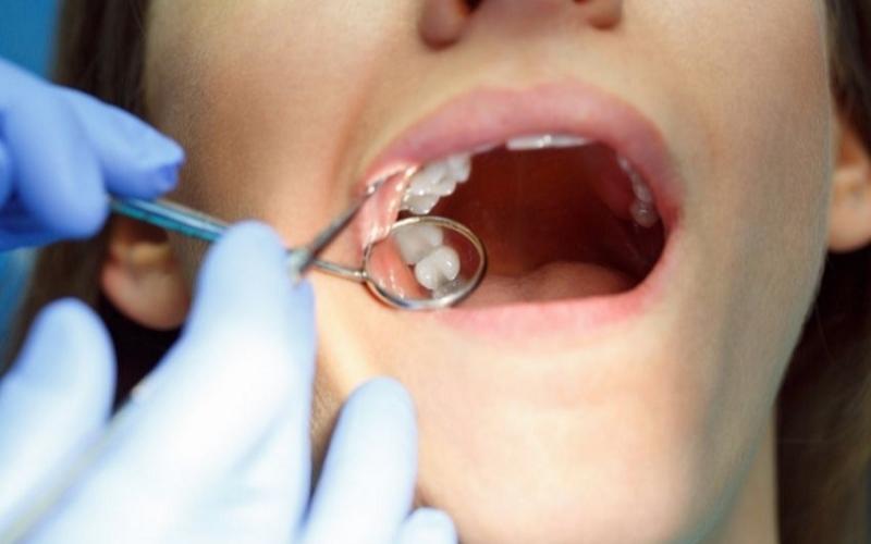 Nha sĩ nhổ các răng khôn để đảm bảo kết quả chỉnh nha tốt hơn