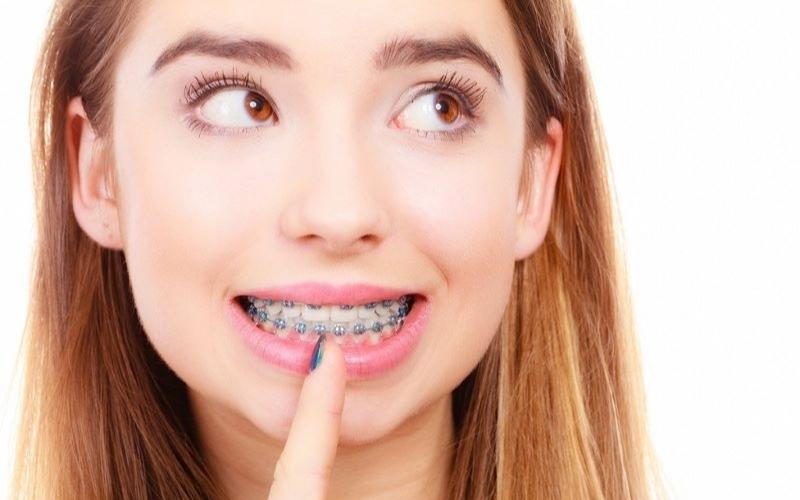 Niềng răng có giảm cân không là thắc mắc của nhiều người