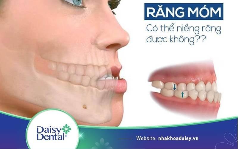 Niềng răng có hết móm không