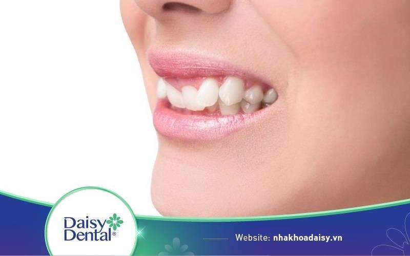 niềng răng cửa bị lệch