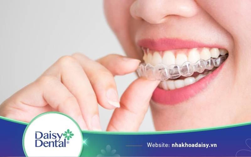 So sánh niềng răng Ecligner và Invisalign? Nên chọn loại nào?