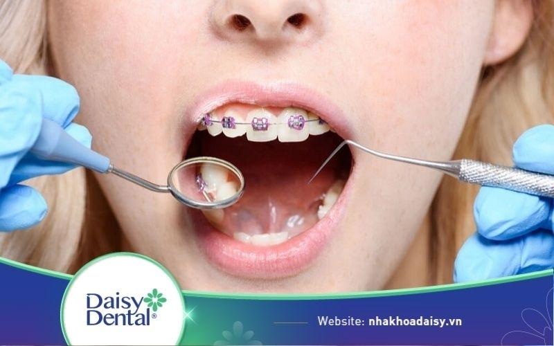 Niềng răng hô có đau không?