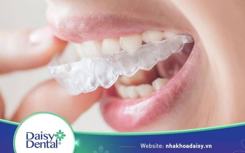 Niềng răng trong suốt có phải nhổ răng không