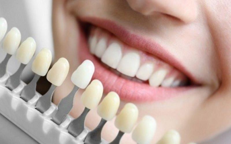 Phủ răng sứ Veneer đem lại hiệu quả thẩm mỹ cao