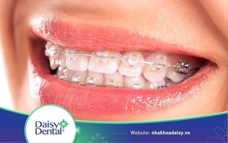 Niềng răng có làm cằm bớt lẹm