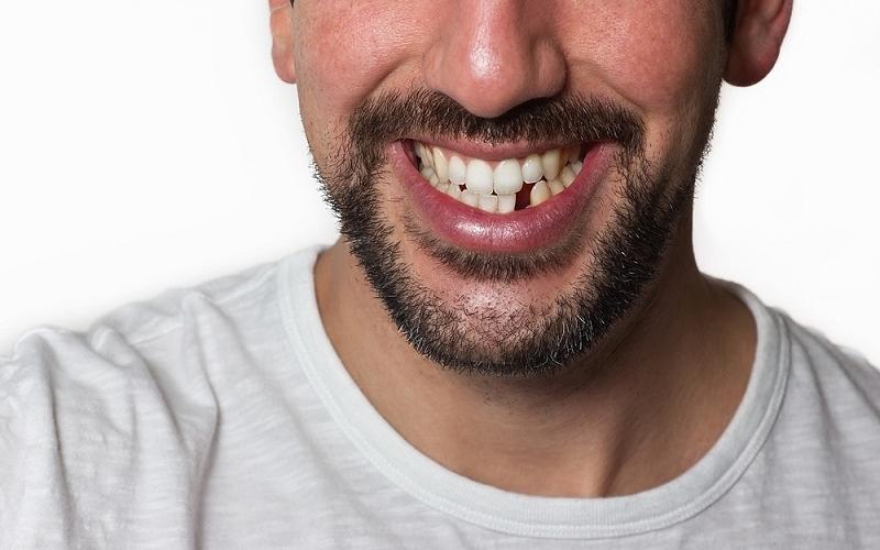 Răng hô là tình trạng răng hàm trên chìa ra quá nhiều so với hàm dưới