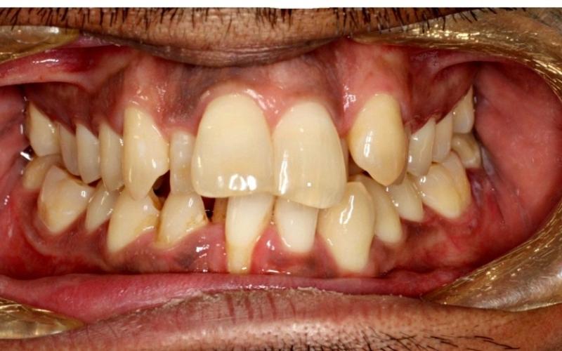 Răng mọc lộn xộn, khấp khểnh nhiều cần phải nhổ bỏ đề chỉnh nha tốt hơn