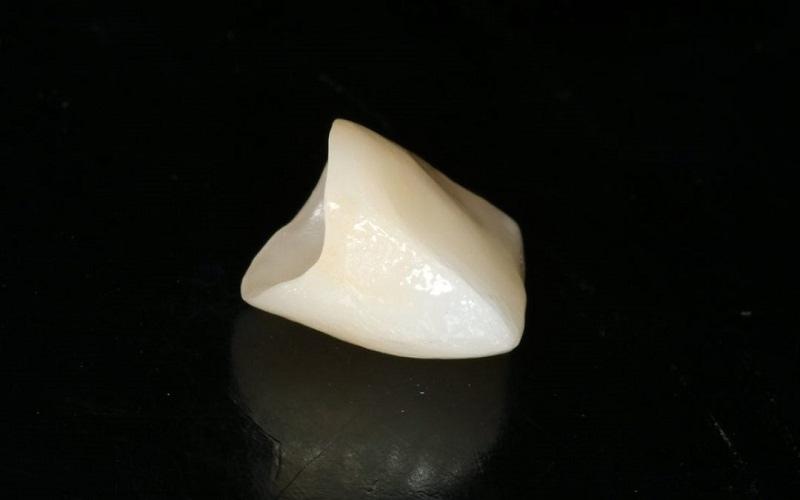 Răng sứ Zirconia có khung sườn bên trong lẫn ngoài bằng sứ 100%