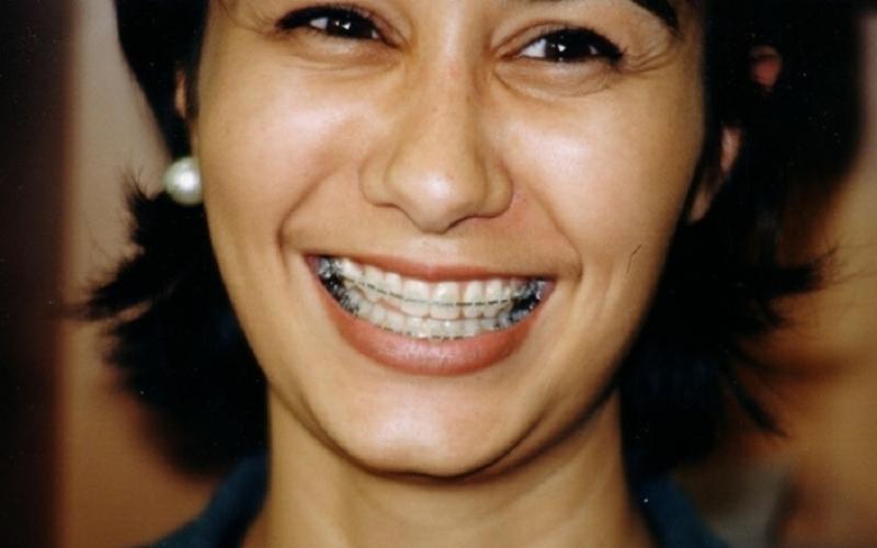 Niềng răng ở giai đoạn lớn tuổi sẽ lâu hơn