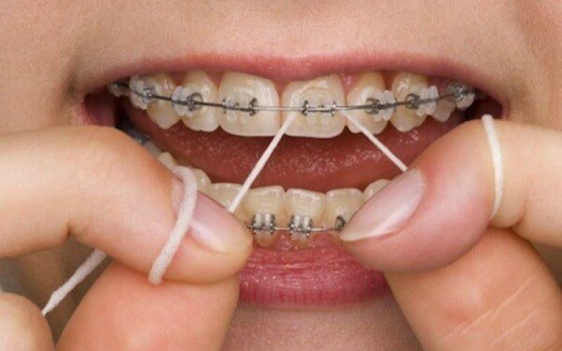 Sử dụng chỉ nha khoa để vệ sinh răng miệng khi niềng răng là điều vô cùng cần thiết