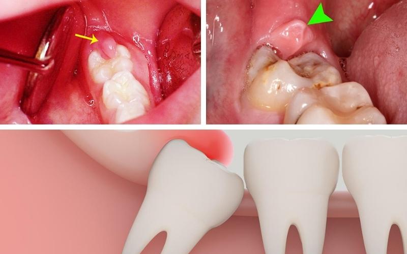Sưng nướu răng trong cùng do nhiều nguyên nhân khác nhau