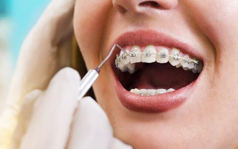 Thời gian đóng khoảng niềng răng sẽ diễn ra từ 4 - 8 tháng