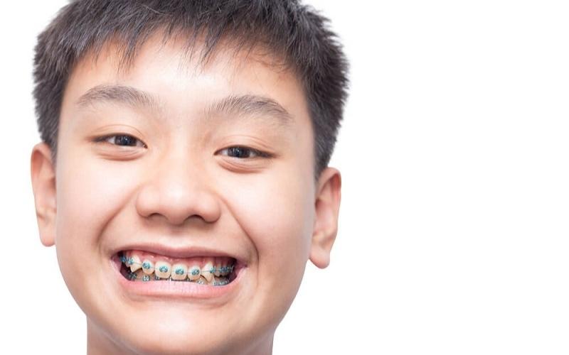Trẻ 7 tuổi nên niềng răng để tạo vẻ đẹp thẩm mỹ gương mặt
