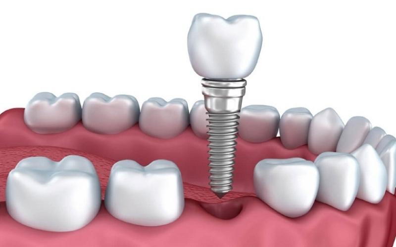 Tiến hành trồng răng Implant để phục hình răng số 6