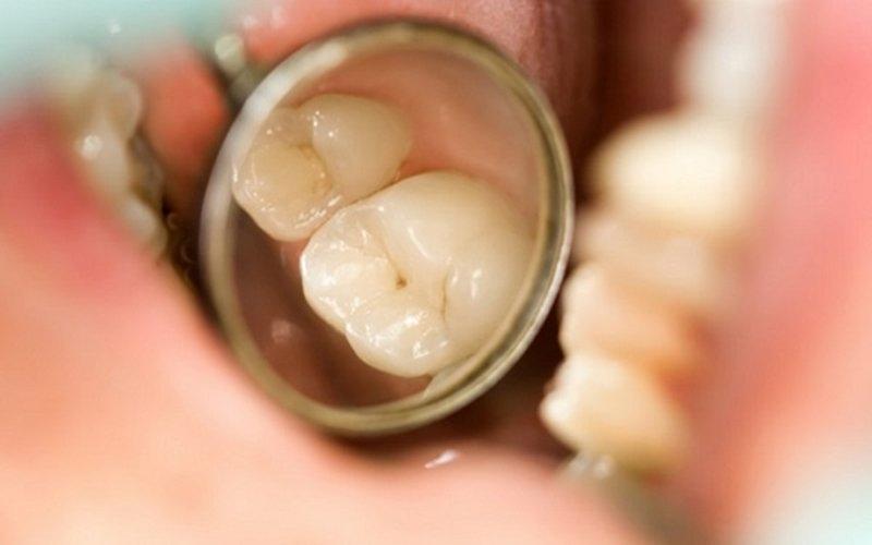 Xác định mức độ răng bị thủng lỗ sẽ giúp lựa chọn phương pháp điều trị phù hợp