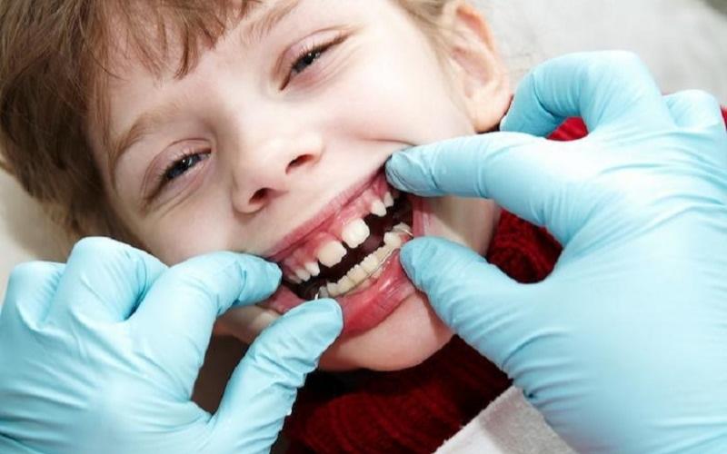 Bé 9 tuổi gặp tình trạng thưa răng nên chỉnh nha